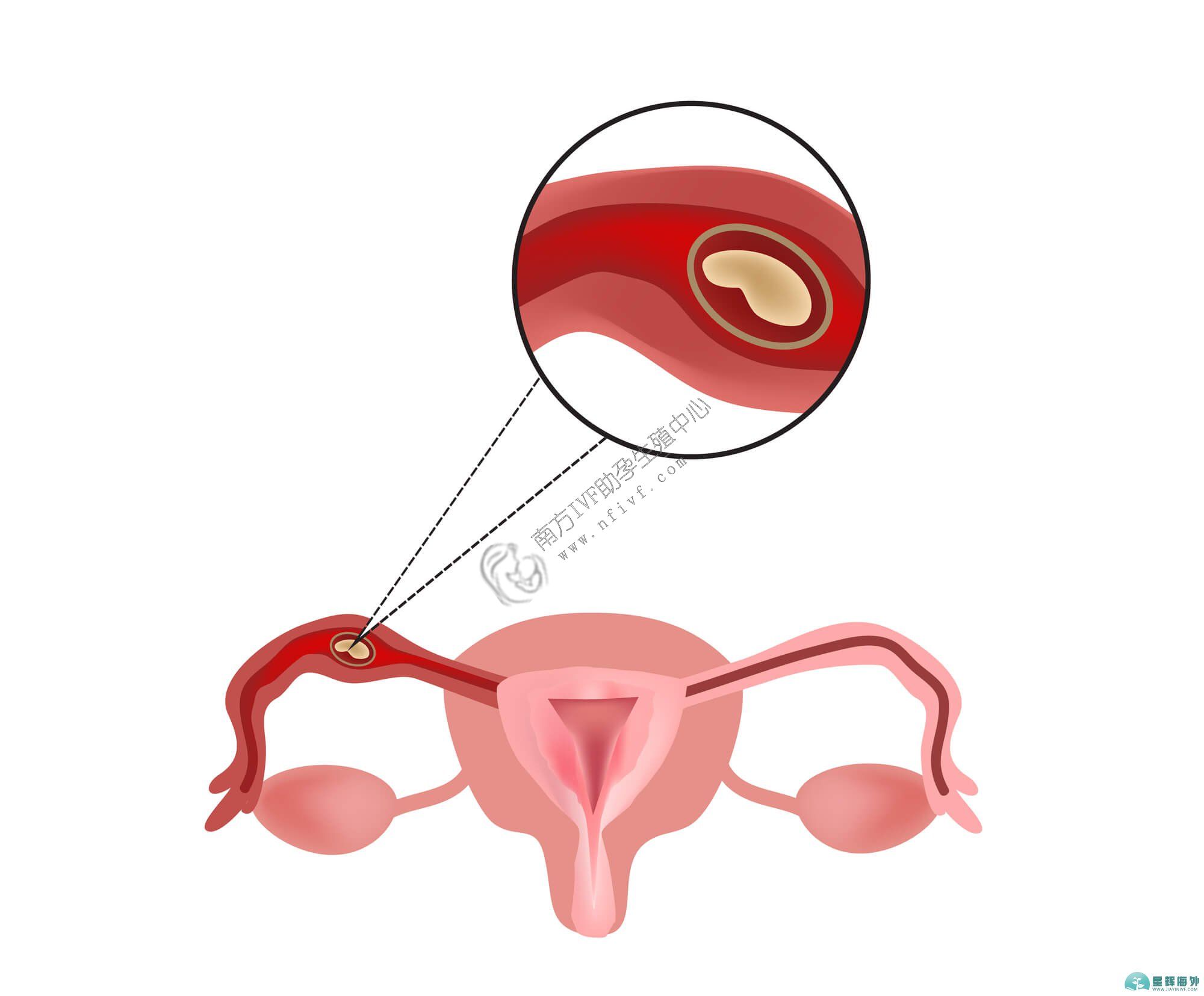 试管婴儿机构
_子宫内膜增生症可以治愈吗？(图1)